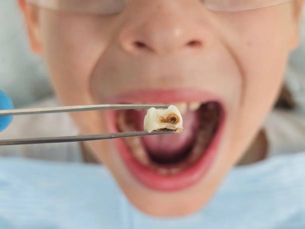 Best Chipped Tooth Repair Near Me  in Gatesville, TX